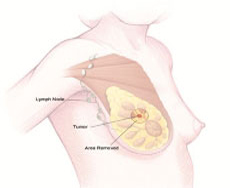 Breast surgery
