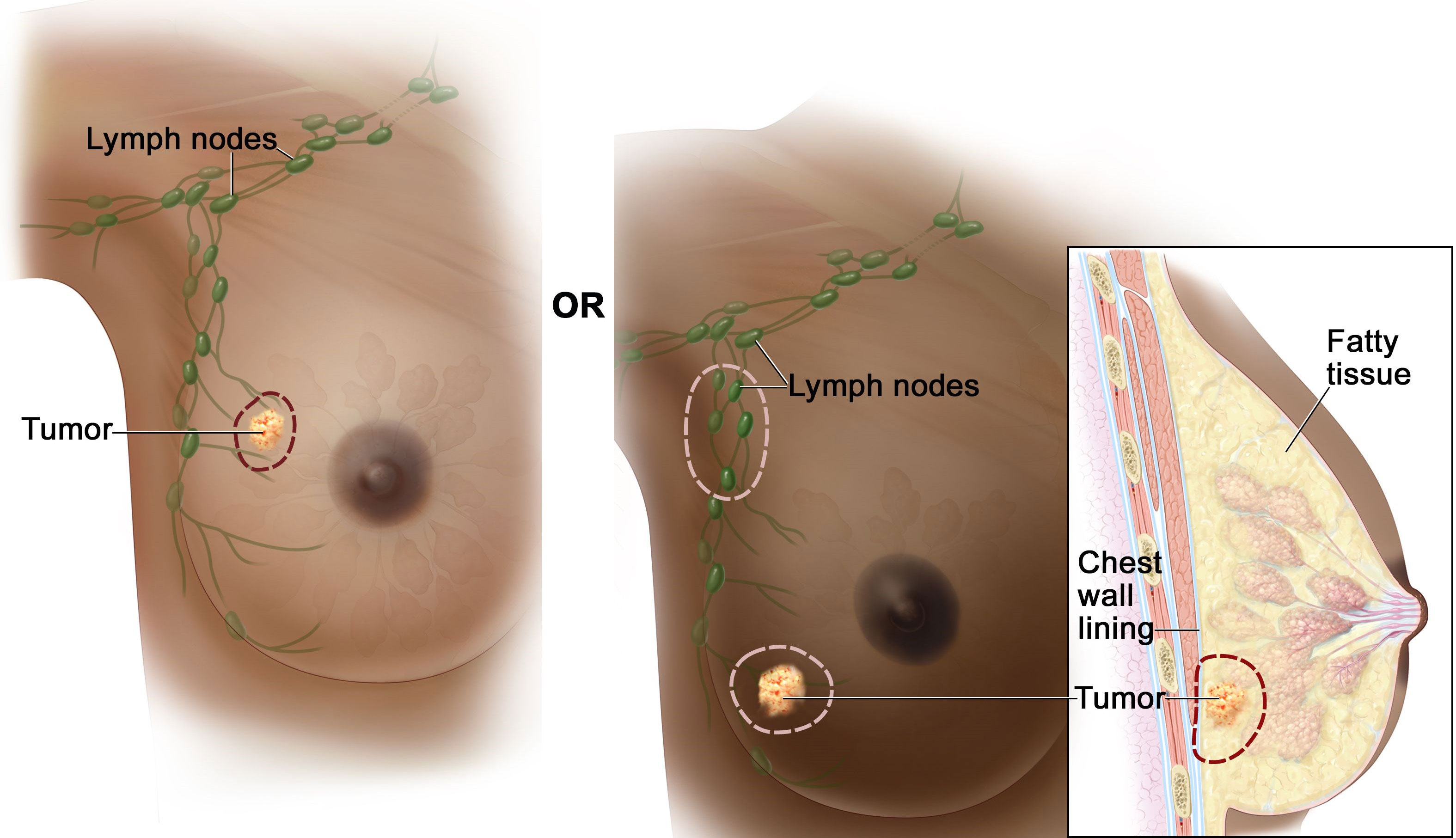 Breast surgery