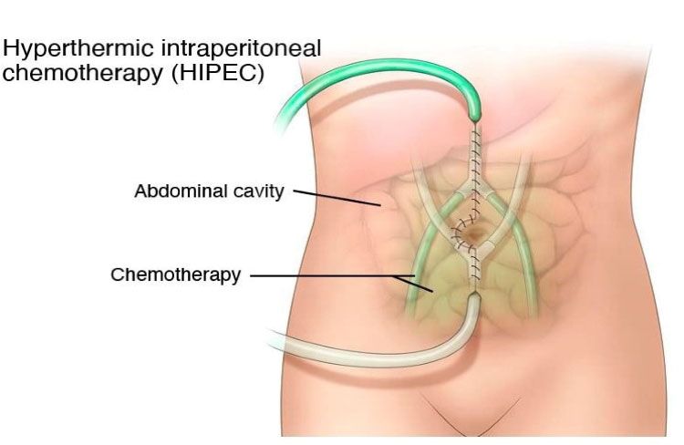 crs-hipac