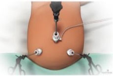 laparoscopic-surgery