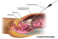 laparoscopic-surgery