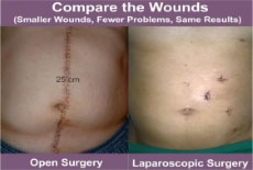 laparoscopic-surgery