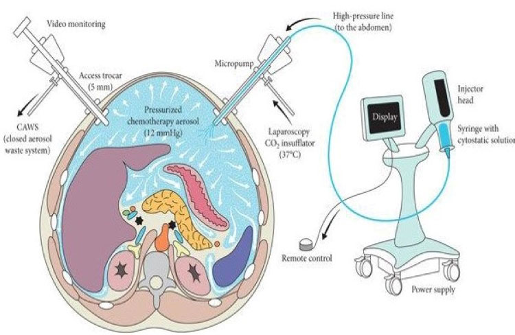 pipac-surgery
